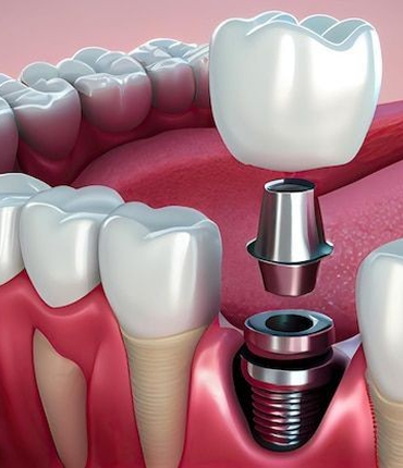 Ilustração educativa de implante dentário